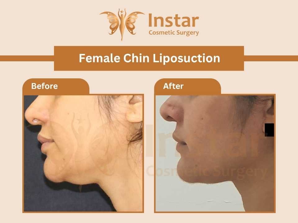 Female double chin-liposuction-2